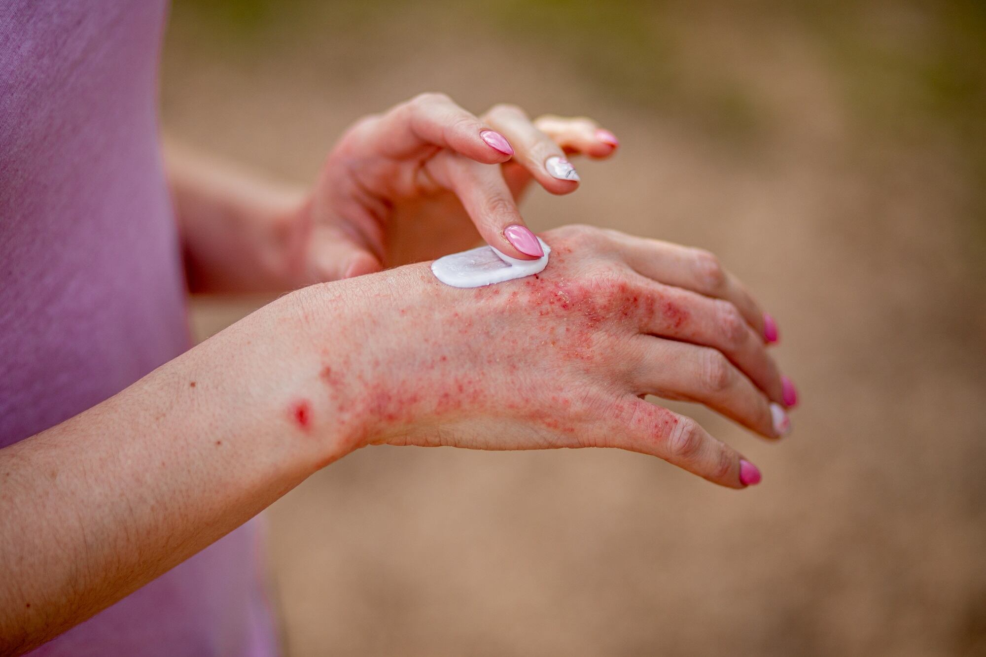 Skin care company launches ‘breakthrough’ psoriasis and eczema product line