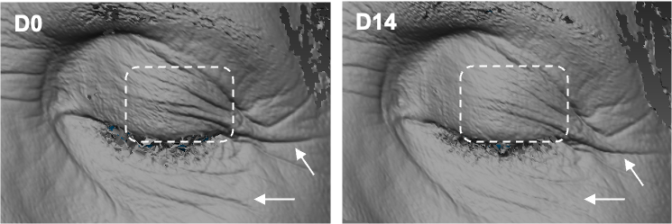 Figure1-Myralys-UpperEyeContour.png