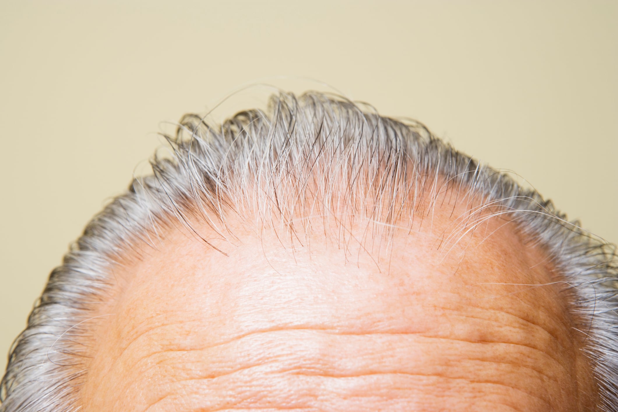 "For a long time, men’s hair thinning has been treated as a one-size-fits-all issue. But, at Nutrafol, we know that is not the case," said Kim Biedermann, chief R&D officer at Nutrafol.