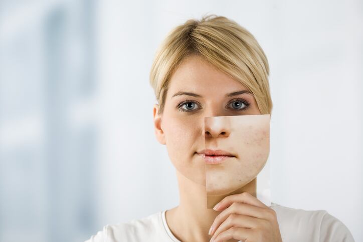 Spot search: L’Oréal files patent for acne imaging tech