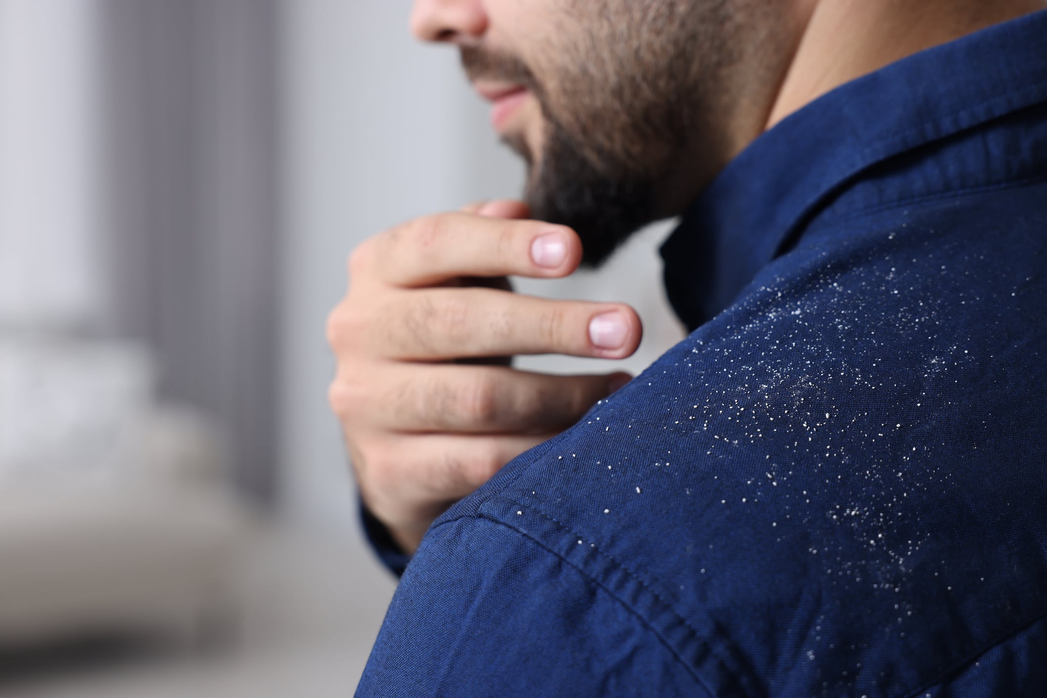 New study finds dandruff relief tied to emotional well-being and daily functioning