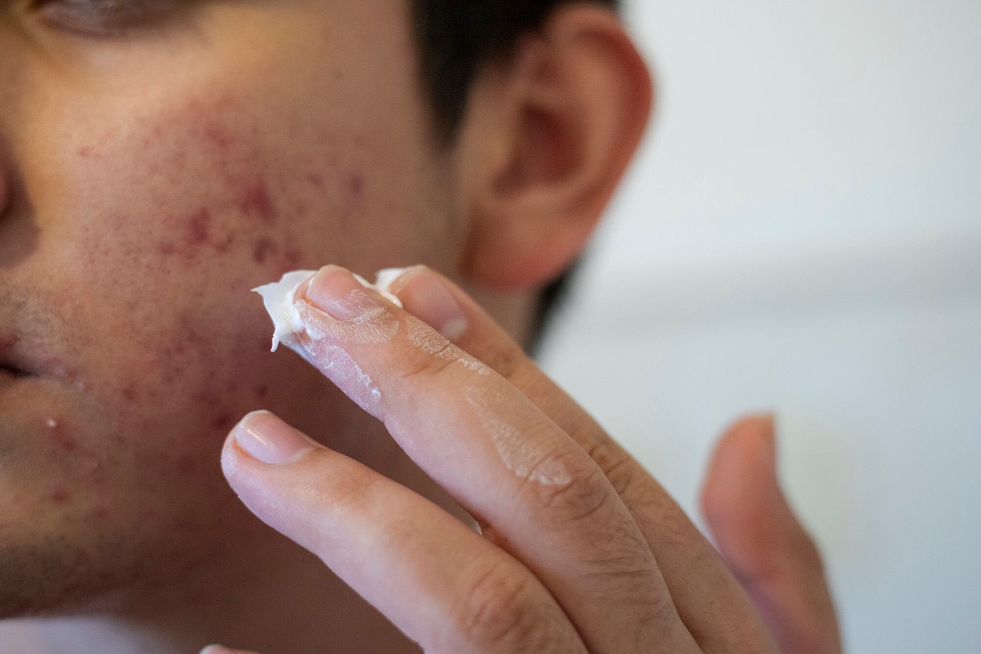 Valisure-submits-Citizen-s-Application-to-FDA-requesting-a-recall-and-suspension-of-sale-of-products-containing-benzoyl-peroxide.jpg
