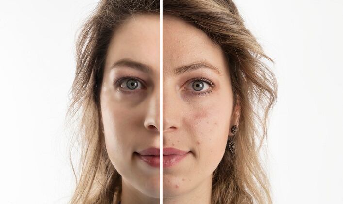 Trend Watch: the new face of acne care