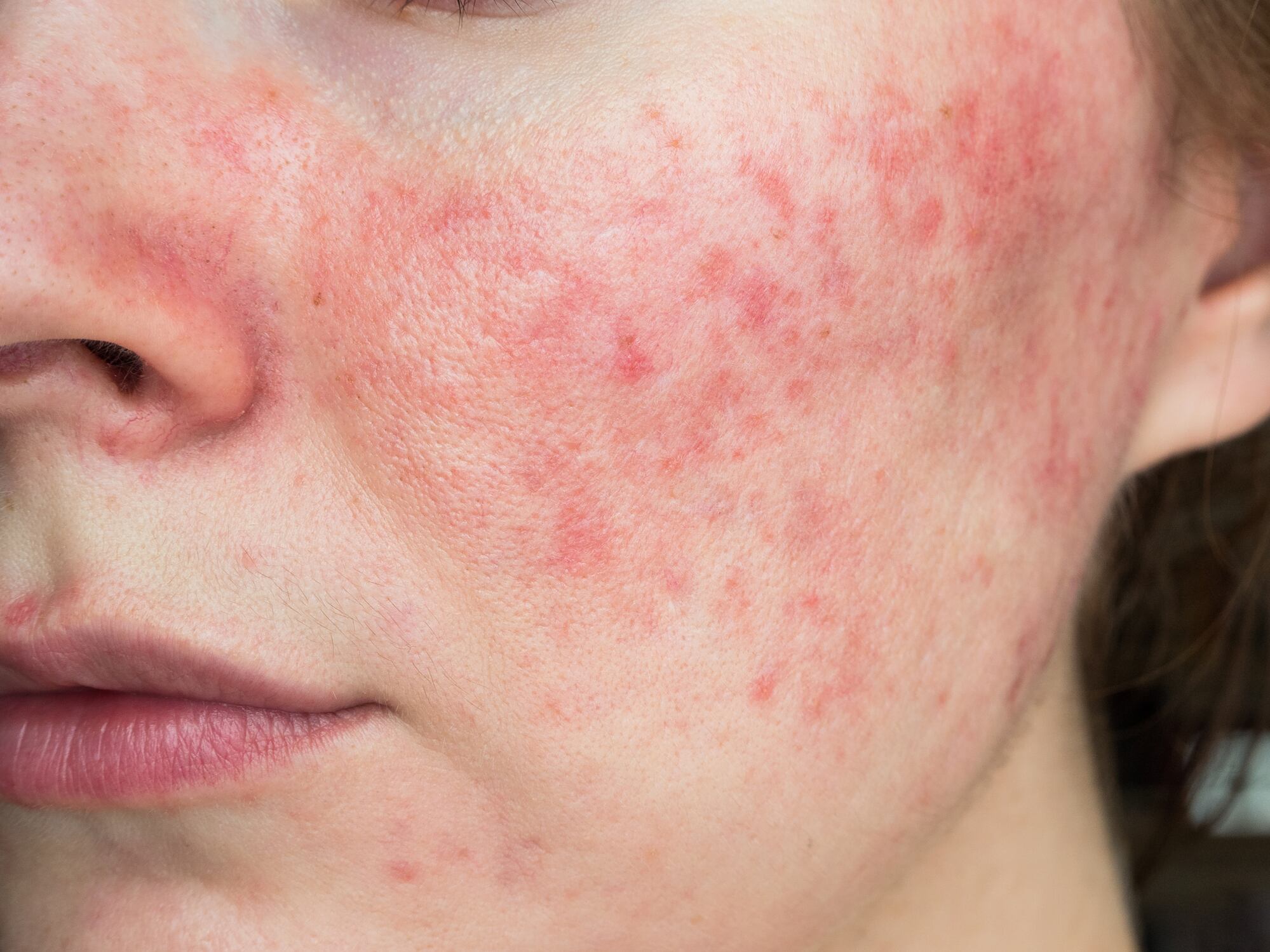 National Rosacea Society launches new Seal of Acceptance Program