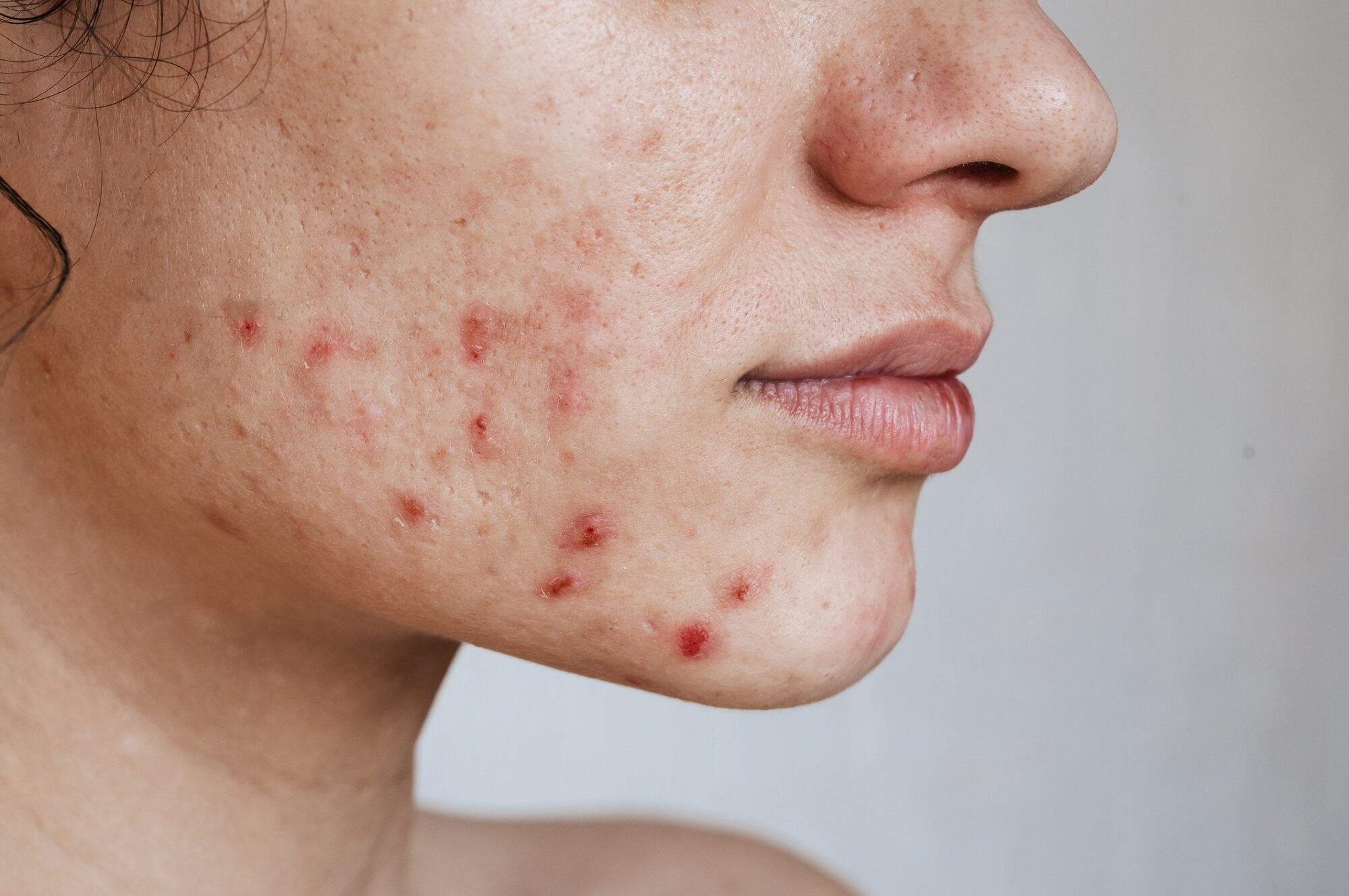 Q&A: Burt's Bees Head of Clinical & Scientific Affairs' insights into AAD 2024 research study presentations 