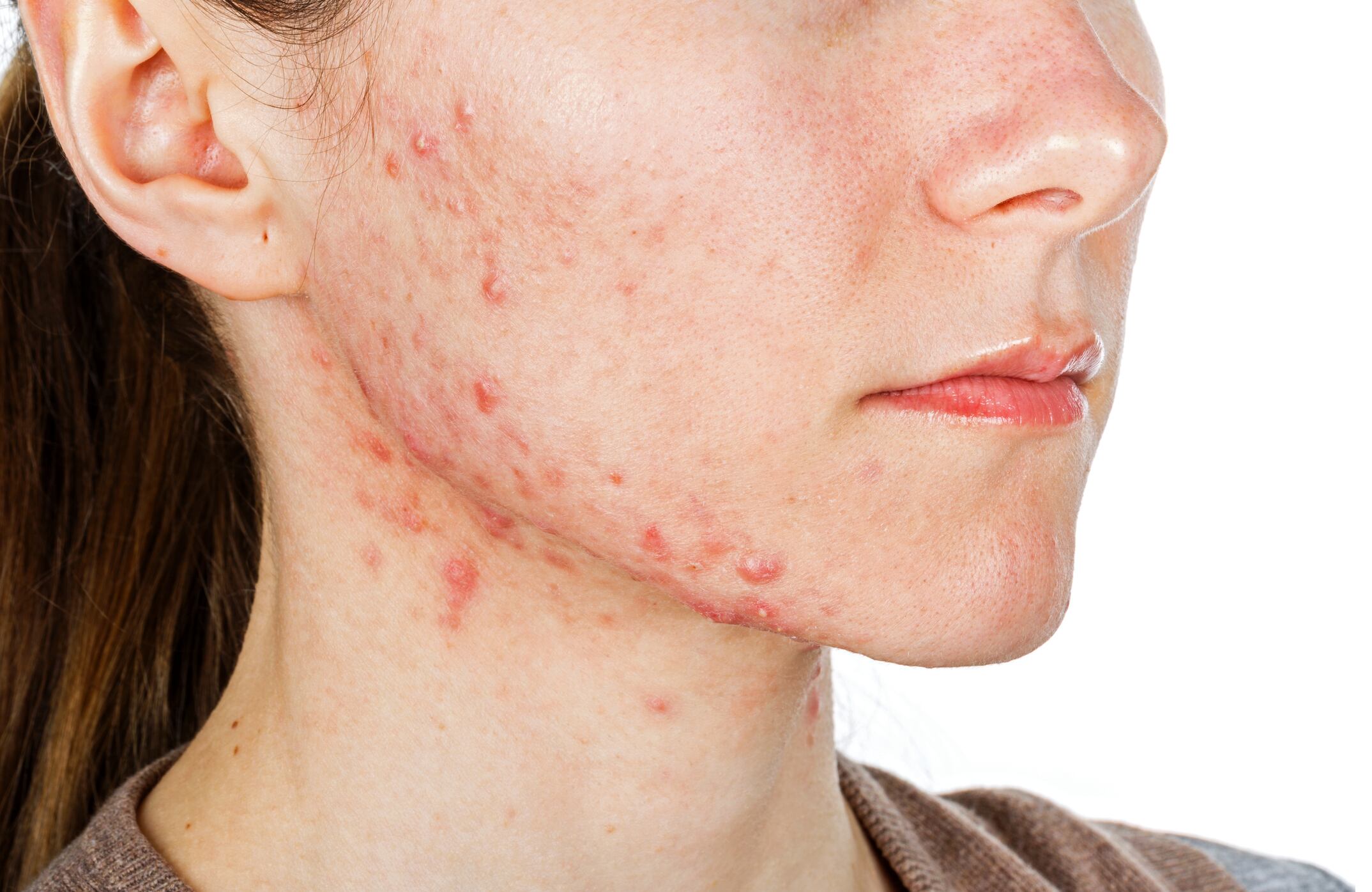 Skin probiotic may offer anti-acne options: Study