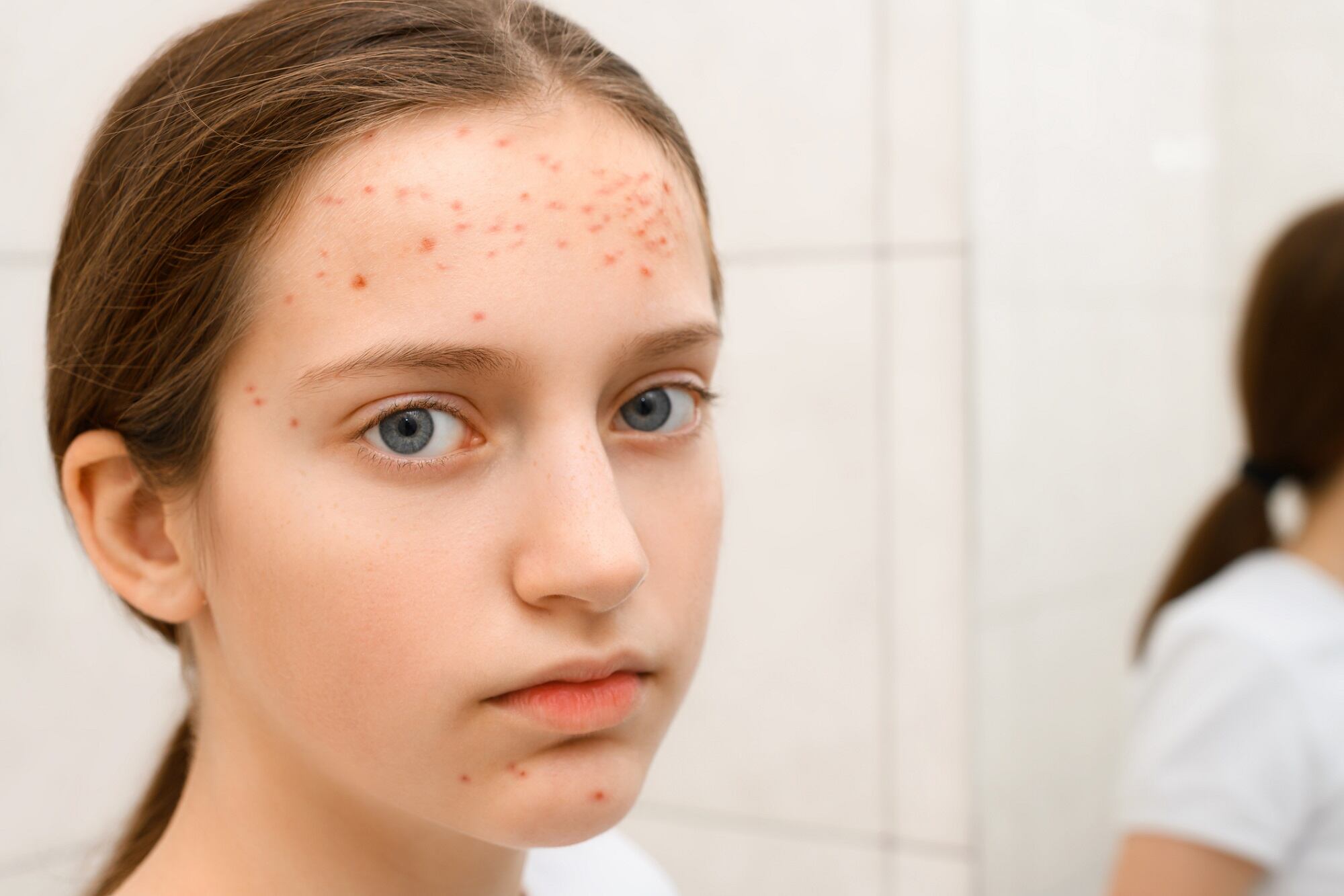 Parents of adolescents say acne is top skin concern for their child: CeraVe survey