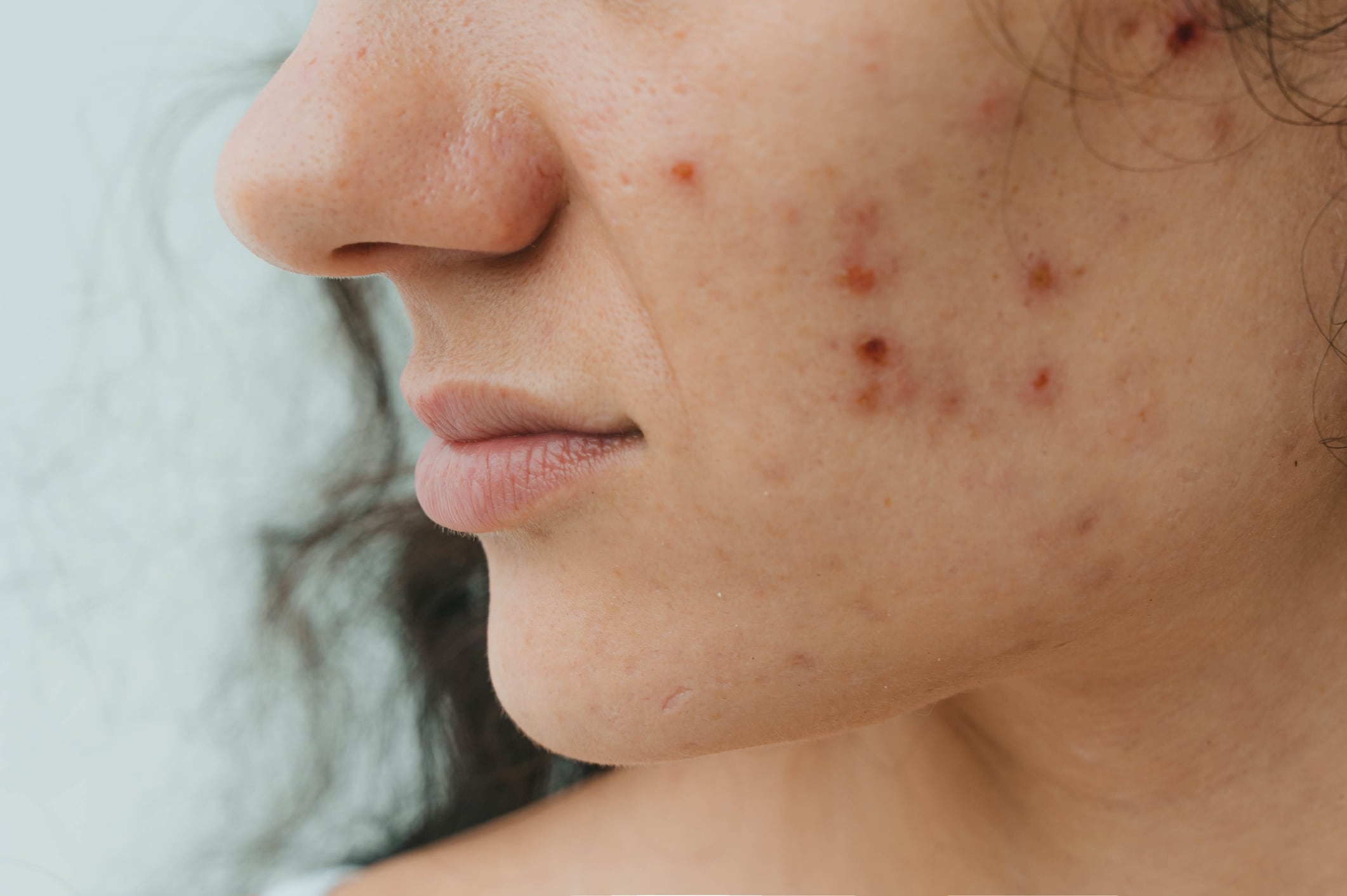 Peer-reviewed trial backs efficacy of Nutrafol Skin in adult women with acne