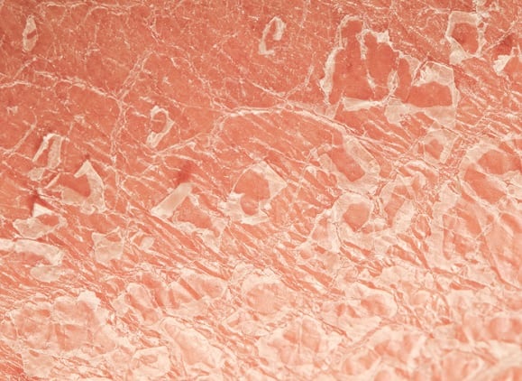 Probiotics can treat psoriasis, shows new clinical data from ADM
