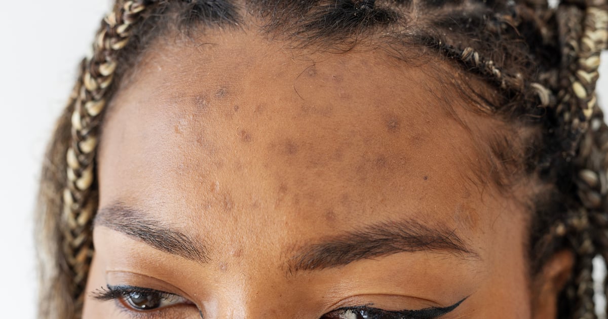 Jellybush honey extract reduces acne scars across skin tones Jellybush honey extract reduces acne scars across skin tones