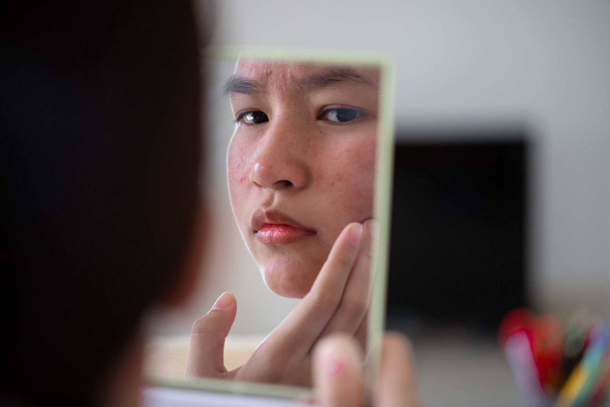 How-Peace-Out-Skincare-is-meeting-Gen-Z-s-acne-care-demands.jpg