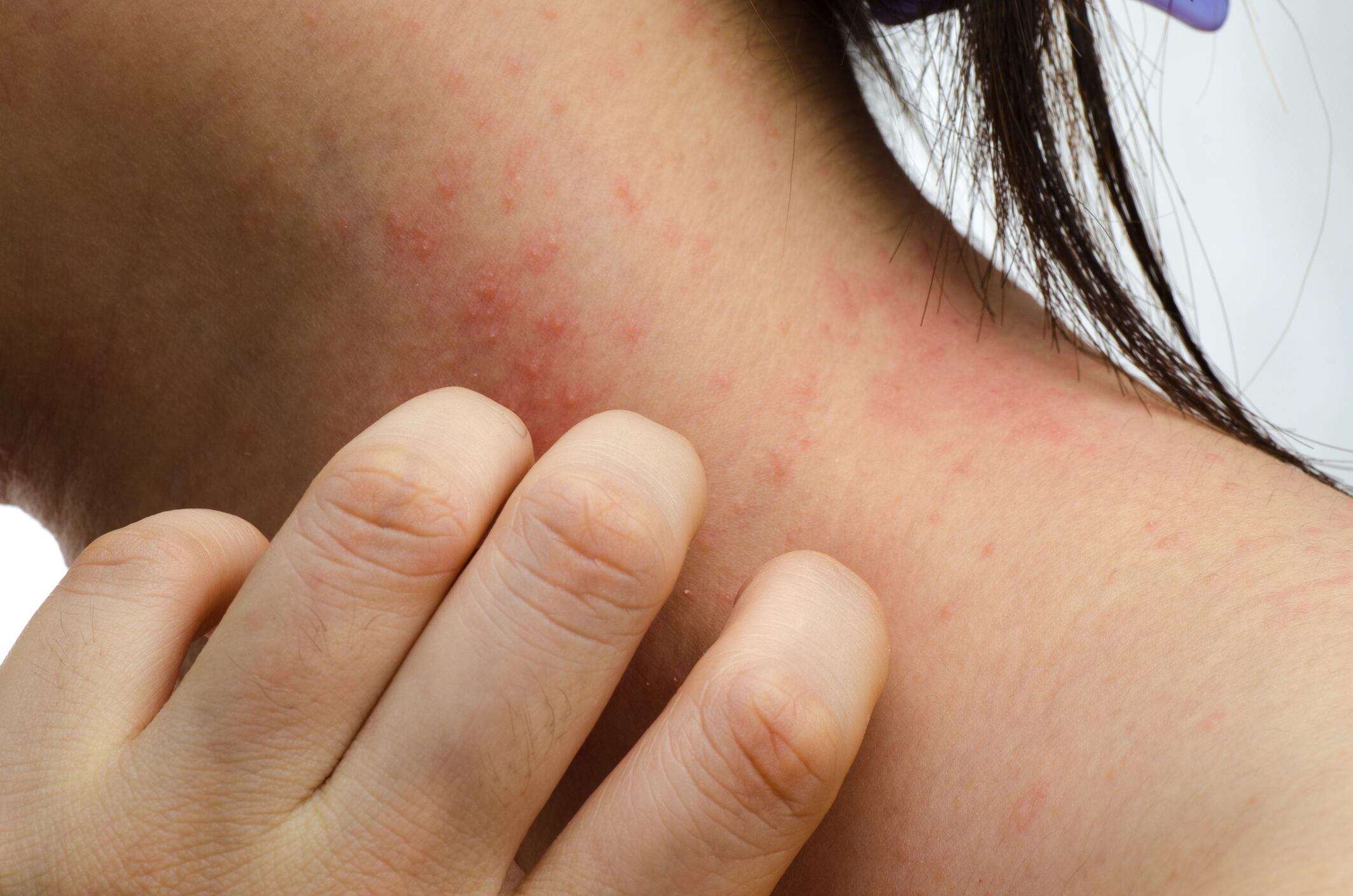 Researchers reveal new skin microbiome opportunities for fucoidan