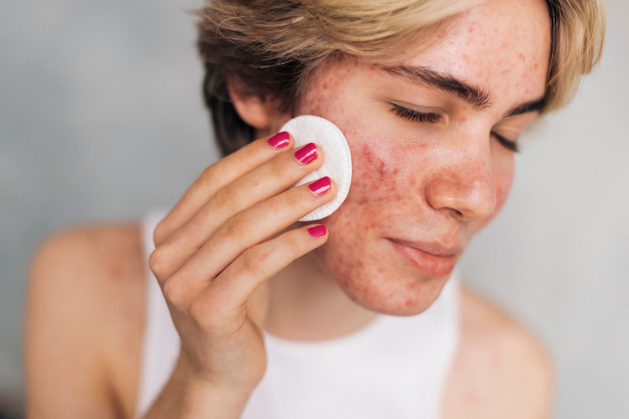 Expert discusses innovation in 'microbiome-selective' bacteriophage ingredient for topical applications