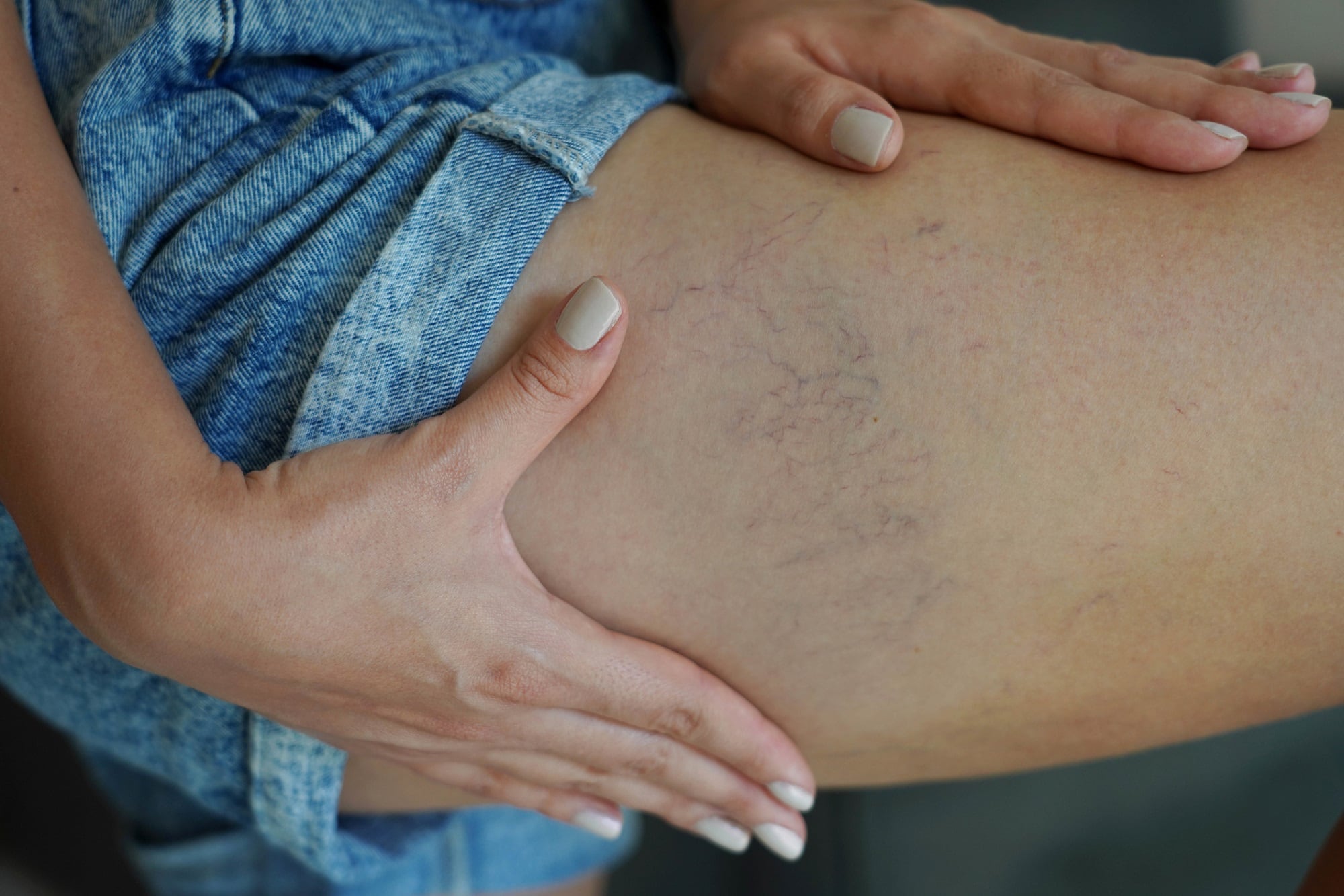 Study shows Pycnogenol effective against post-spider vein treatment skin discoloration 