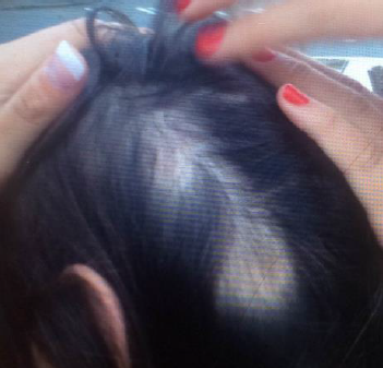 Images of hair loss filed in the complaint