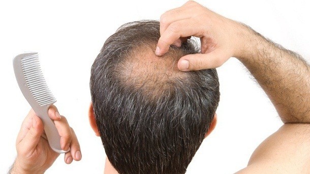Guys, losing your hair? It could be gravity’s fault…