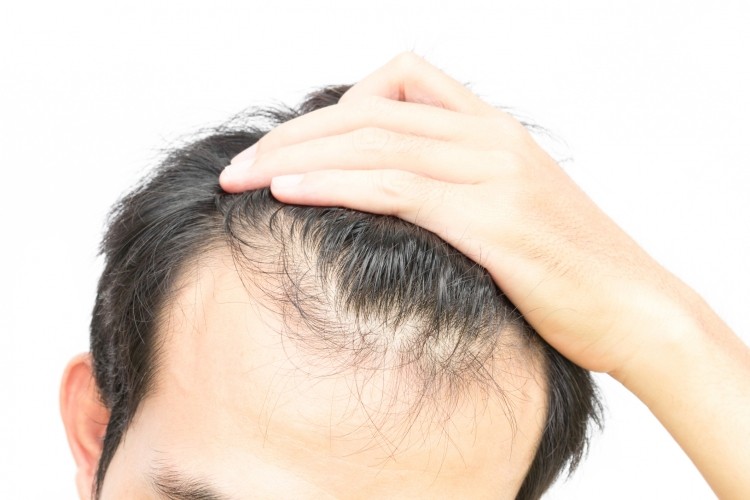 Anti-hair loss potential in broccoli extract finds study