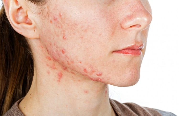 The new study suggests that micro-encapsulation of select probiotic strains may help manage acne.   Image © Obencem / Getty Images 