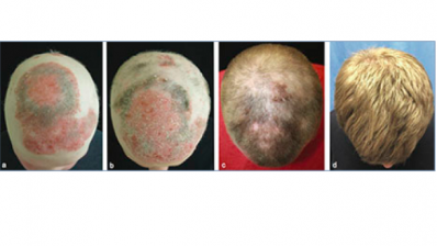 Arthritis drug helps alopecia sufferer regrow hair