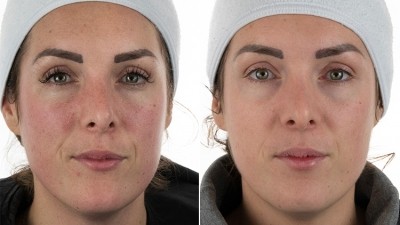 TXVector™ for Age Spots, Sun Damage, and PIH