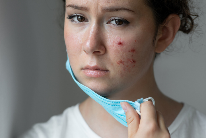 study on mask acne mental health impacts and acne treatment